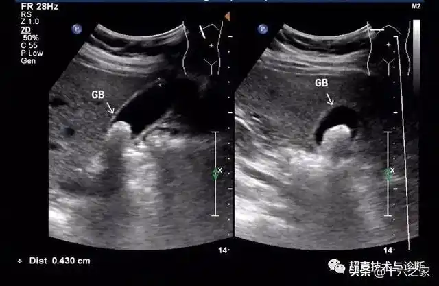 腹部超声 | 不典型胆囊结石——泥沙样结石