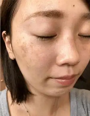 仅需洁面后敷20分钟,  脸上的小斑点直接就淡了下去,脸上干干净净的