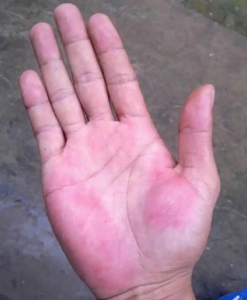 好多人都在后台给我留言发图片 问她的手掌发红是不是肝掌,大家都知道