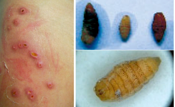 能钻到人的大腿里面的虫是什么虫子?