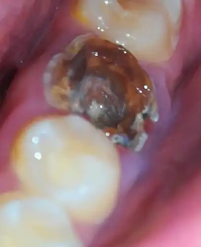 牙齿烂成这样怎么治,根管治疗之后有烂.