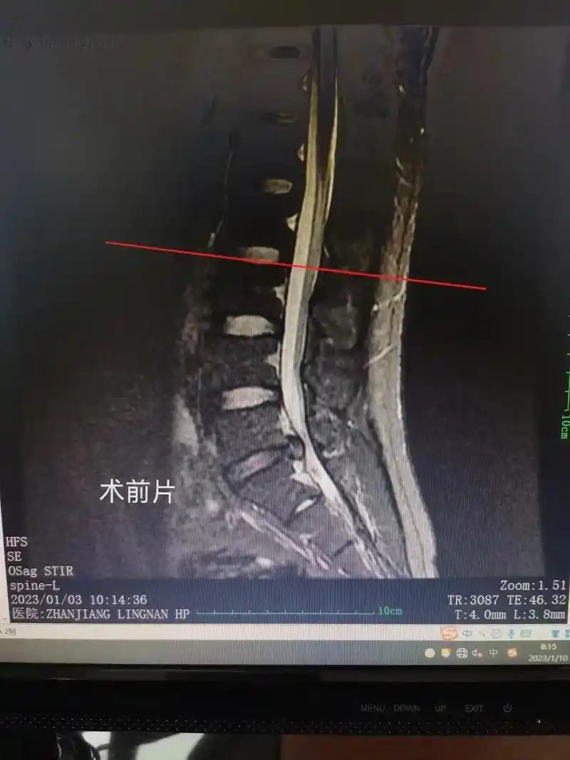 腰椎间盘突出症,术后复查突出髓核消失.这个患者,女性,42岁 - 抖音