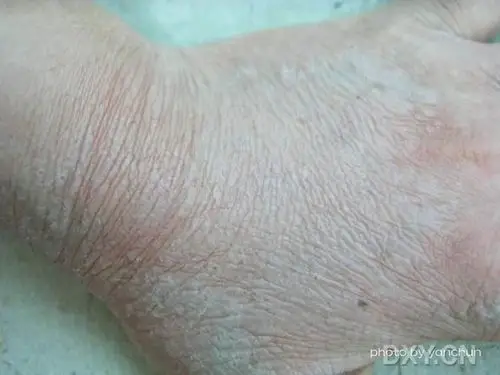 【病例讨论】水源性掌跖角化病(aquagenic palmoplantar keratoderma)