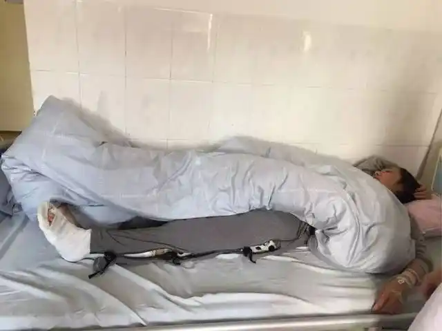 遇到意外导致股骨,胫骨骨折的情况,这时候就需要骨骼牵引或石膏固定