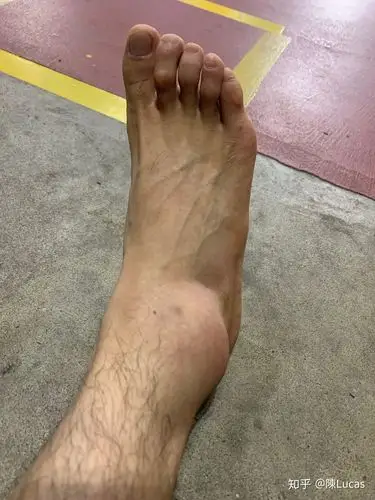 记录韧带断裂 - 知乎