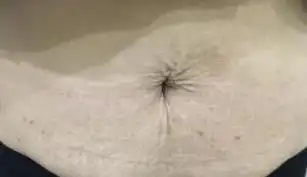 妊娠纹做微磨皮半年图片小腹皮肤摸起来手感特别哈嫩嫩滑滑的