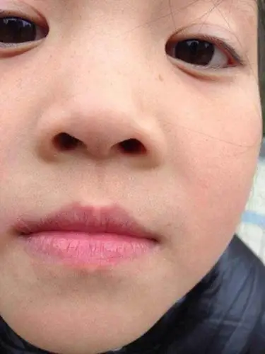 嘴唇发紫图片43