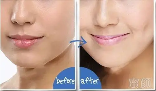 酒窝再造丨梨涡浅笑不是梦-蜜颜整形优惠