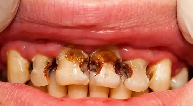 也就是说,即使吃糖,也不会长蛀牙,但如果不注意清洁,孩子就会蛀牙