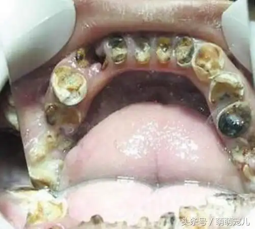 19岁男孩每天喝十公斤可乐导致牙齿腐烂,只能靠假牙度日