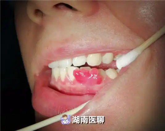 准妈妈怀孕27周,牙龈上竟长出"疙瘩"?孕期口腔保健很重要