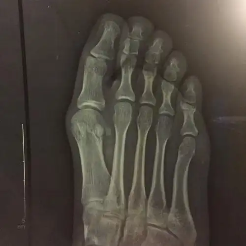 小脚趾骨裂,这是一个月后拍的片,刚受伤时候医生没有让打石膏,在家