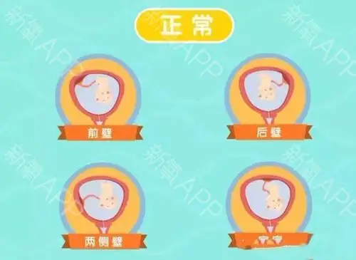 怀孕前壁后壁的区别是什么?