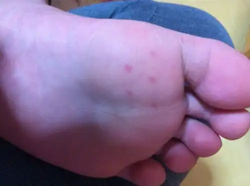 孩子脚底起红点,14岁,说不疼,几个月前