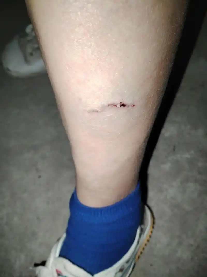 被狗咬了,以为打免疫球蛋白是最疼的,没想到后期更疼,两三天了 - 抖音