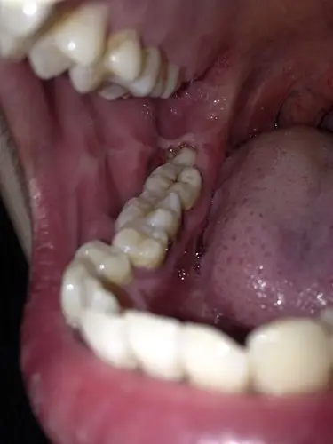 智齿发炎,我这情况是智齿冠周炎么,脸颊有点小肿,牙冠长出来一半,还有