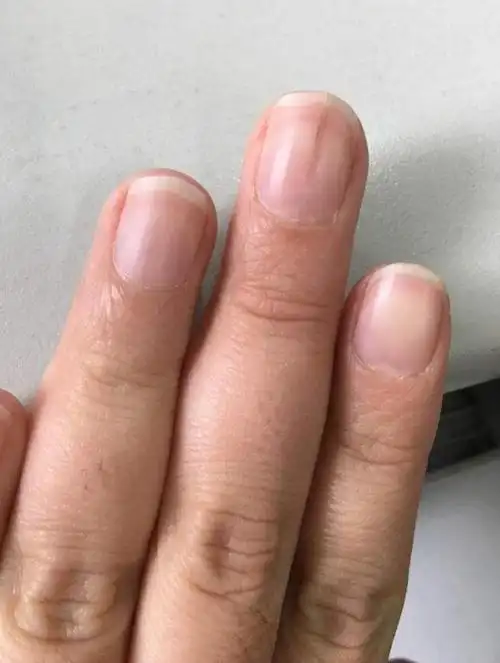 肝脏好不好看看手指就知道分享给您如何从手指甲判断肝脏健康