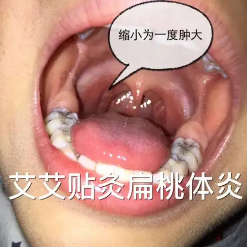 艾艾贴 ——调理小朋友扁桃体发炎 肿大