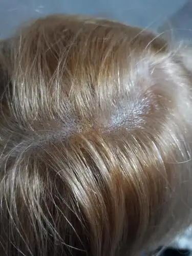 漂发染发后头皮溃烂流脓多处结痂这是正常现象吗有图慎点