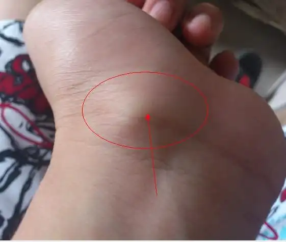 您好,腱鞘炎可以安揉吗