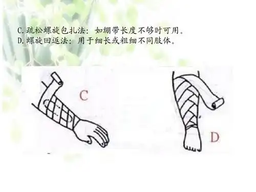 疏松螺旋包扎法:如绷带长度不够时可用. d.