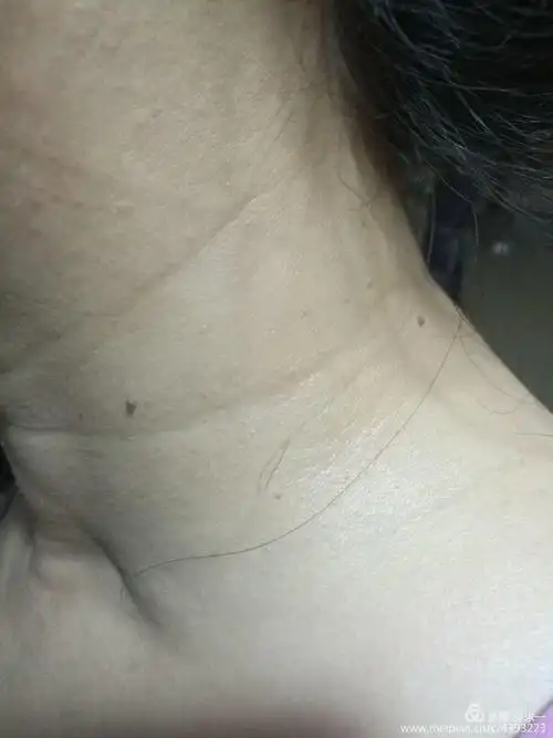 自拟落疣液愈疣实例二(河北中医学院侯仙明教授皮肤病验案系列)