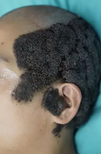 患者表现为头面部大面积疣状黑痣,日常中黑痣分泌大量油,散发难闻气味