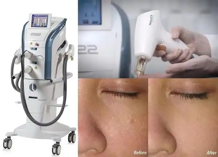 干货|不是所有的光子嫩肤都是aopt超光子