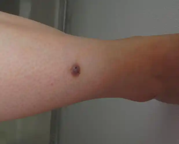 10 患者信息:女24岁病情描述(发病时间,主要症状等):小腿前有一小腿前