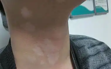 脖子上最近刚长了几个白点点什么原因