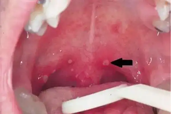 小儿疱疹性咽峡炎进入高发期,家长们准备好应对了吗?