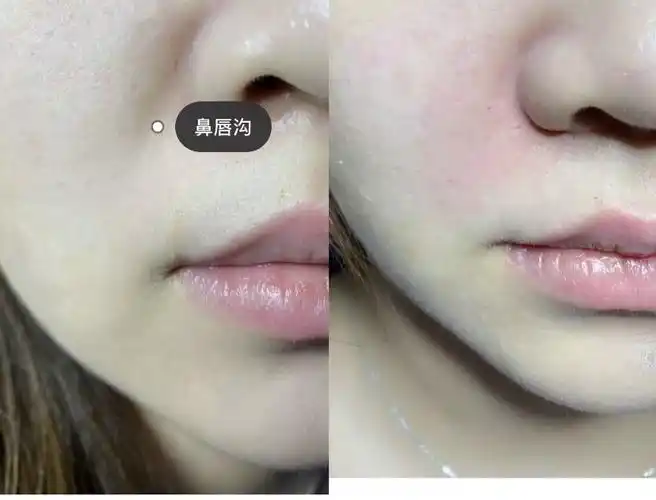 右侧鼻唇沟消失的图片