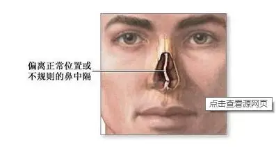 鼻中隔弯曲的临床表现