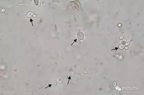 9岁女孩,尿常规竟然发现阴道毛滴虫
