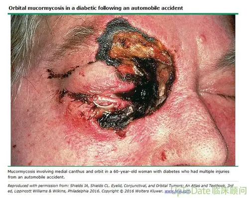 高能慎点印度多个邦爆发新冠康复者感染毛霉菌病例继黑色霉菌和白色