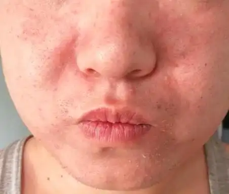 脸上长癣怎么办最快治疗方法(脸上起癣怎么快速去掉?