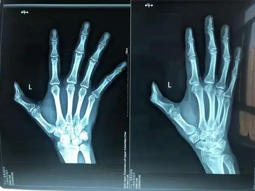 弘慈医疗集团中化二建医院 骨科 手外组 功能重塑