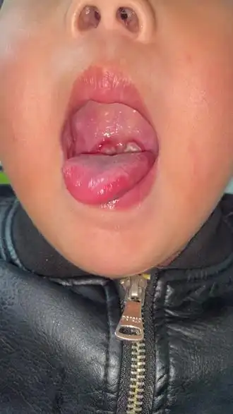 宝宝的喉咙经常这样起泡化浓这是怎么回事