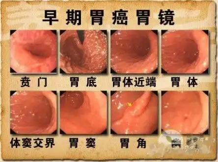 5个症状不能耽误,一拖就会成胃癌!