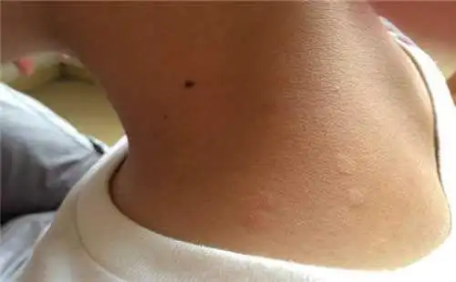 汗斑的治疗方法(汗斑的最佳治疗方法)