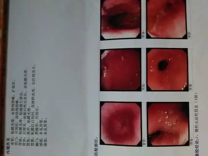 是否就是萎缩性胃炎?能治愈吗?请求多方给予意见!