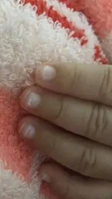 一个半月的小孩子十个手指甲发白怎麼回事?
