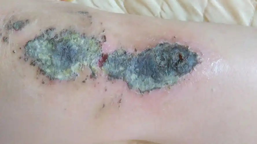 膝盖摔伤了 伤口挺深 已经结痂了 在吃头孢擦百多邦 伤口周围红红的我