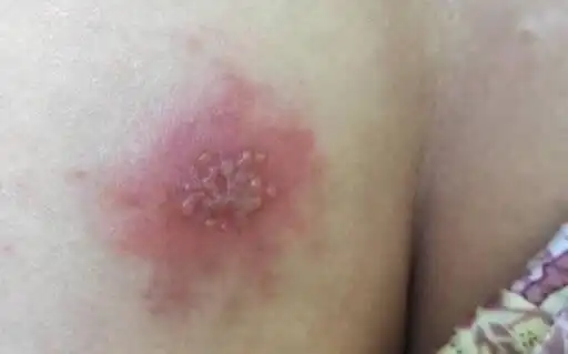 什么是花柳病图片是什么样子 花柳病简介