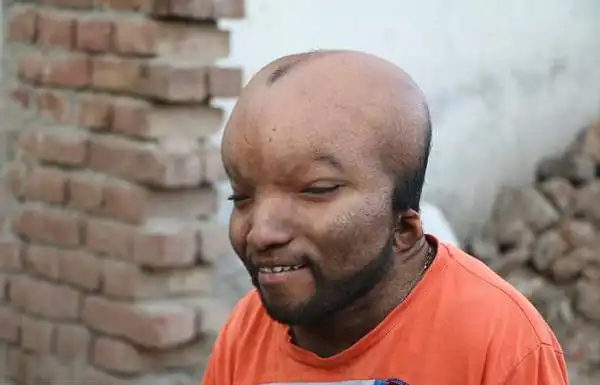 印男子患怪病脑袋胀大眼睛深陷被叫外星人