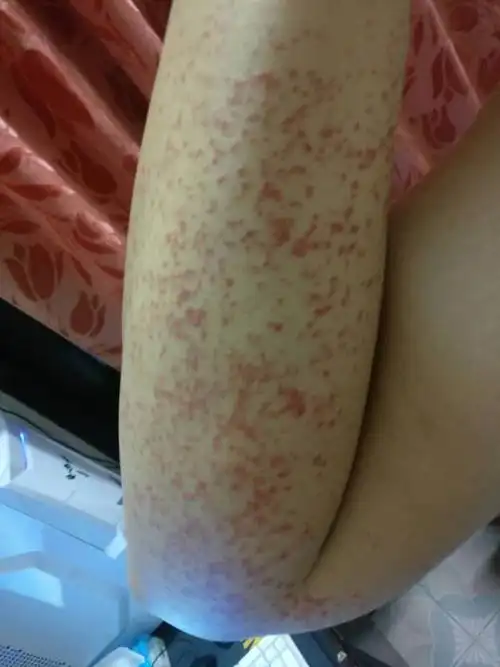 手臂跟大腿小腿长红疹但是不痛不痒可是面积很大过几天就会消失然后又