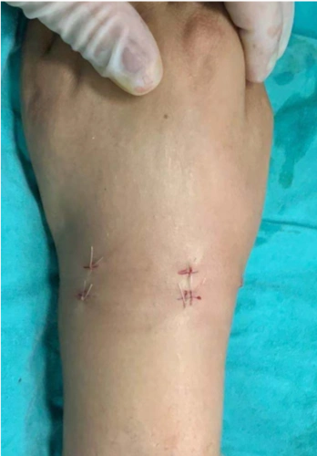 手腕部关节镜微创手术和开放手术的疤痕对比_关节镜_关节镜介绍 - 好