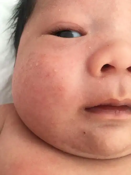 有没有谁家宝宝脸上长这样的痘痘
