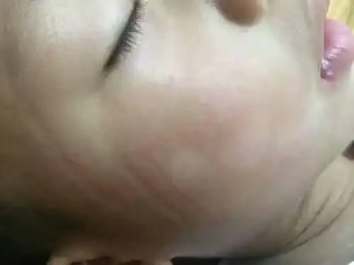 蛔虫脸上白斑图片 (40)_有来医生