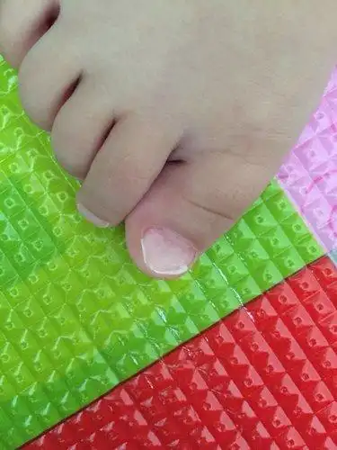 宝宝十七个月脚指甲凹陷 缺什么呢